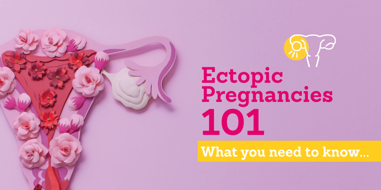 Ectopic pregnancies2.png
