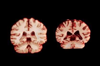Healthy and alzheimers affected brains comparison.jpg