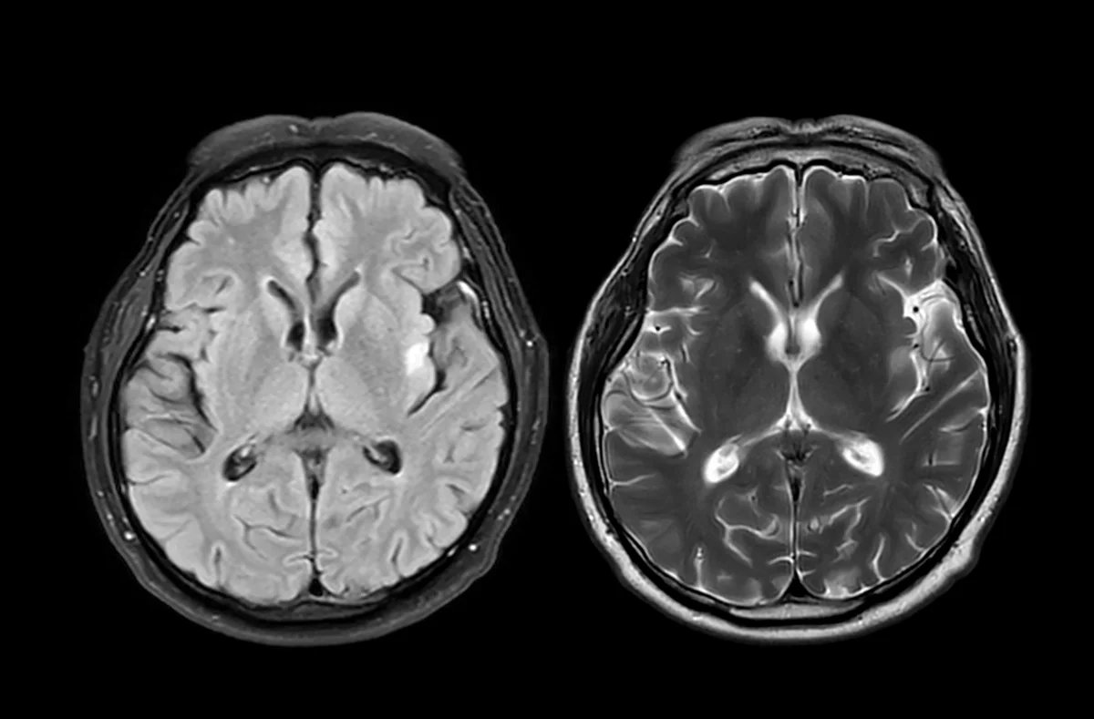 Pandemic brain age lead image.jpg