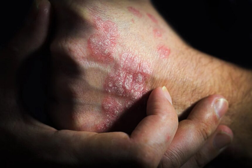 Psoriasis.jpg